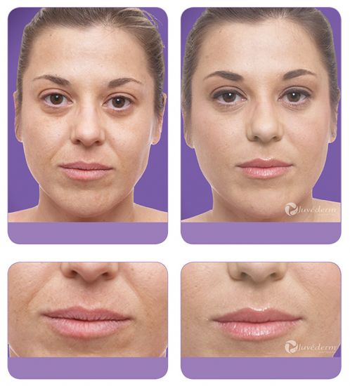 JuvÉderm® Ultra Plus Xc Richmond Dermatology 